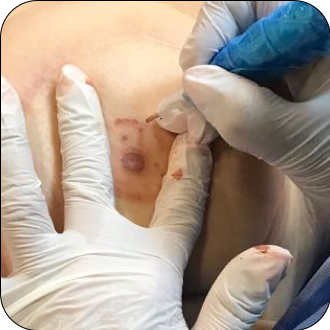 Areola Reconstruction